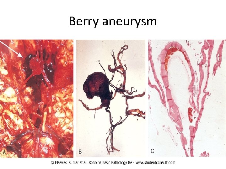 2 Subarachnoid Hemorrhage Causes A Saccular berry aneurysm
