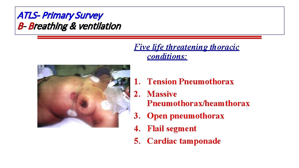 ATLS- Primary Survey B- Breathing & ventilation Five life threatening thoracic conditions: 1. Tension