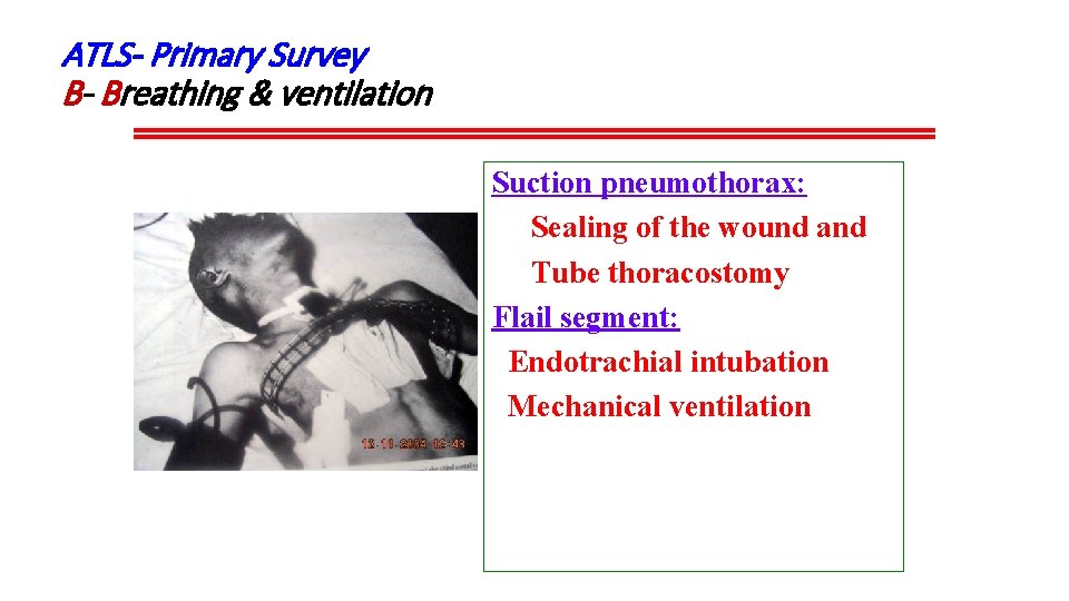 ATLS- Primary Survey B- Breathing & ventilation Suction pneumothorax: Sealing of the wound and