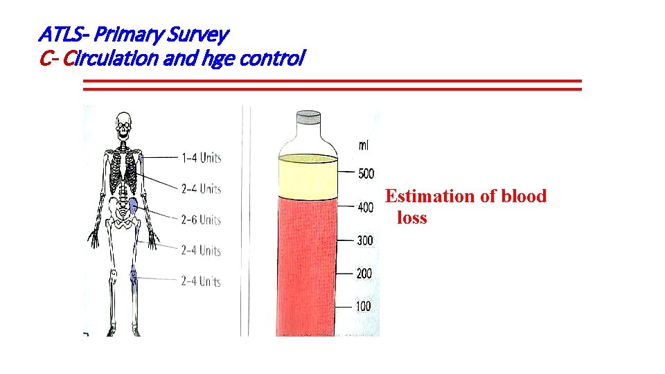 ATLS- Primary Survey C- Circulation and hge control Estimation of blood loss 