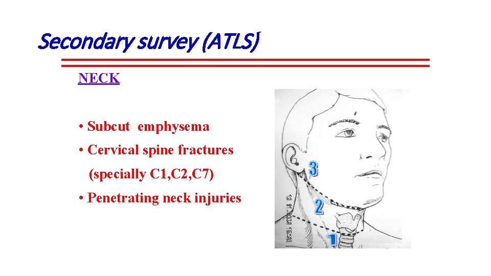 Secondary survey (ATLS) NECK • Subcut emphysema • Cervical spine fractures (specially C 1,