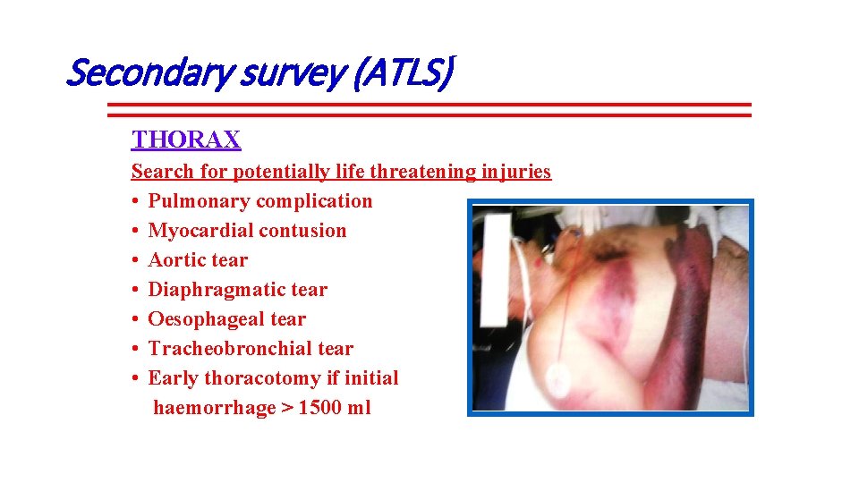 Secondary survey (ATLS) THORAX Search for potentially life threatening injuries • Pulmonary complication •