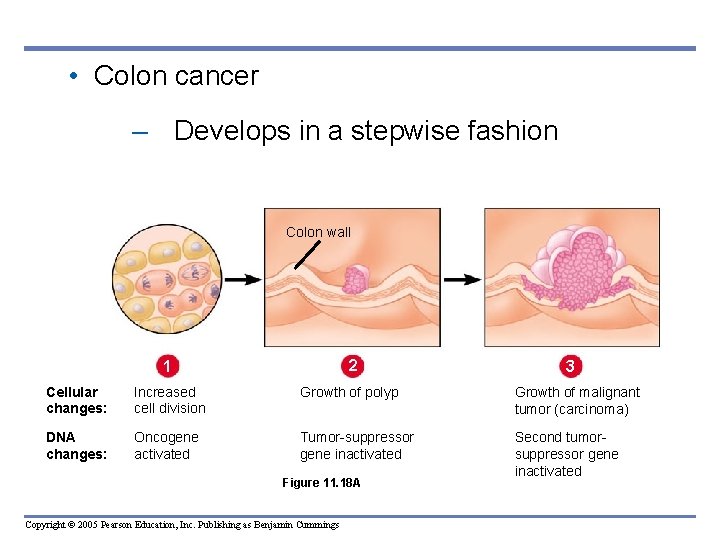  • Colon cancer – Develops in a stepwise fashion Colon wall 1 2