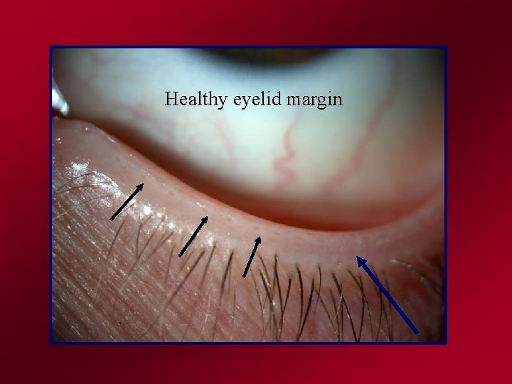 Healthy eyelid margin 