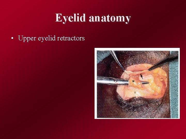 Eyelid anatomy • Upper eyelid retractors 