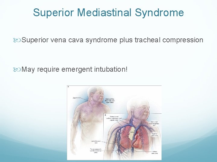 Superior Mediastinal Syndrome Superior vena cava syndrome plus tracheal compression May require emergent intubation!