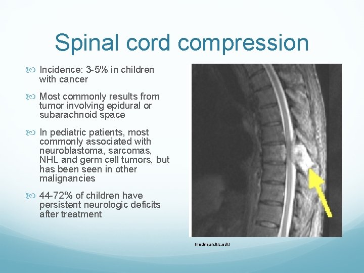 Spinal cord compression Incidence: 3 -5% in children with cancer Most commonly results from