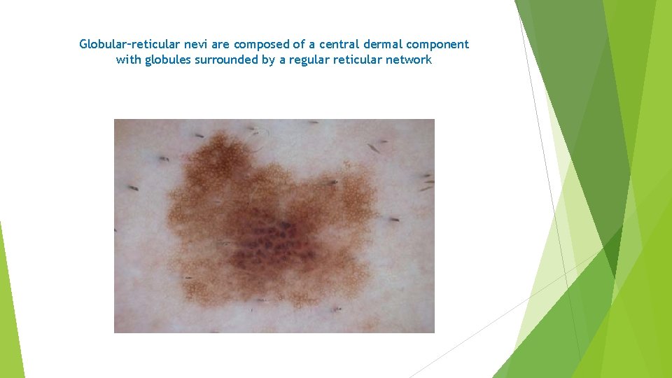 Globular–reticular nevi are composed of a central dermal component with globules surrounded by a