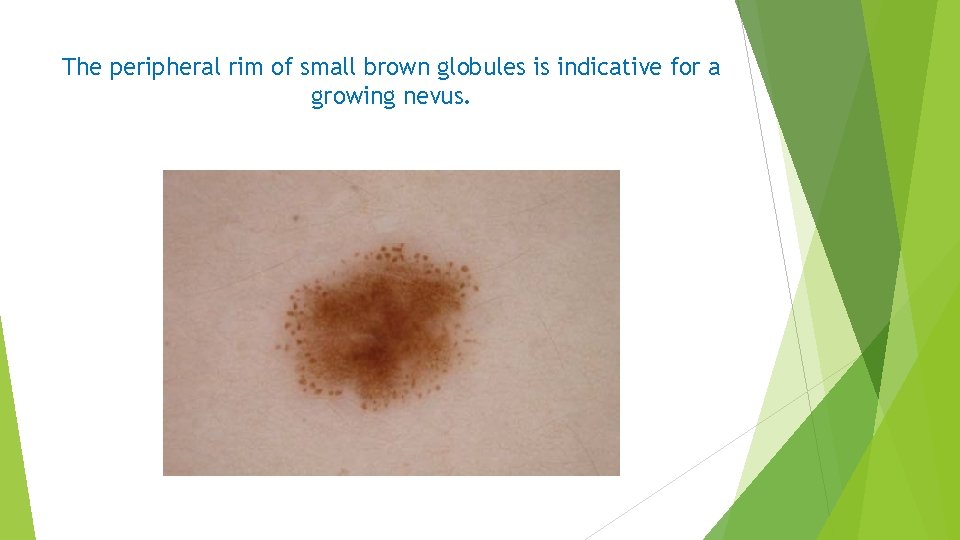 The peripheral rim of small brown globules is indicative for a growing nevus. 