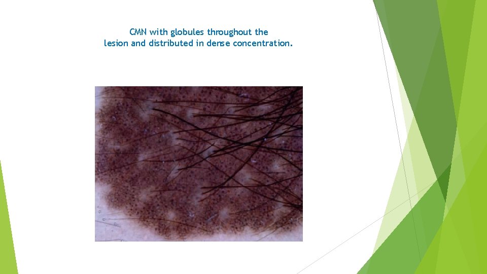 CMN with globules throughout the lesion and distributed in dense concentration. 