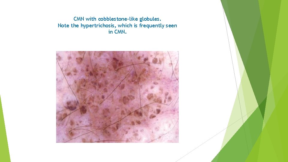 CMN with cobblestone-like globules. Note the hypertrichosis, which is frequently seen in CMN. 