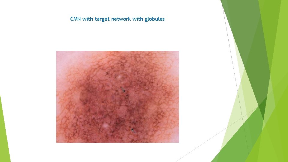 CMN with target network with globules 