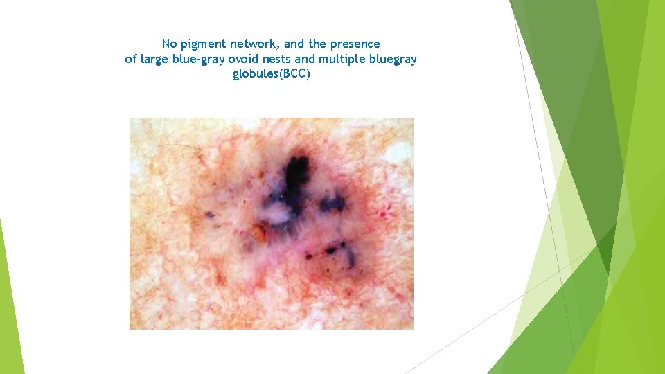 No pigment network, and the presence of large blue-gray ovoid nests and multiple bluegray