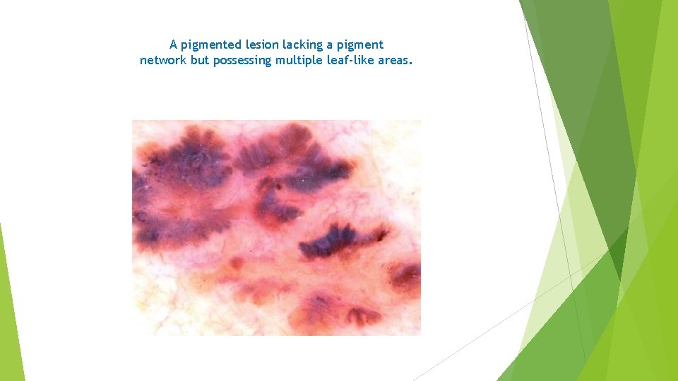 A pigmented lesion lacking a pigment network but possessing multiple leaf-like areas. 