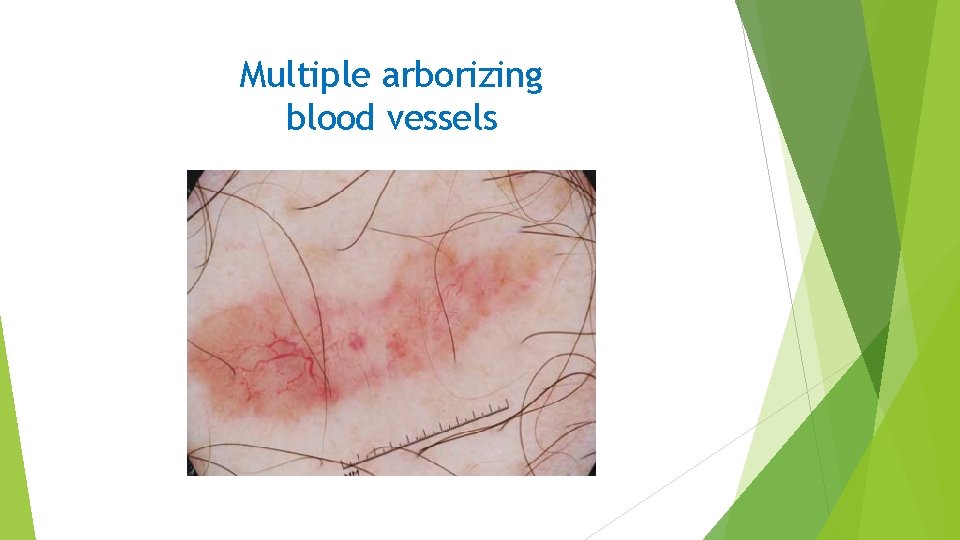 Multiple arborizing blood vessels 