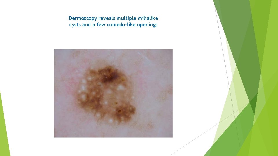 Dermoscopy reveals multiple milialike cysts and a few comedo-like openings 