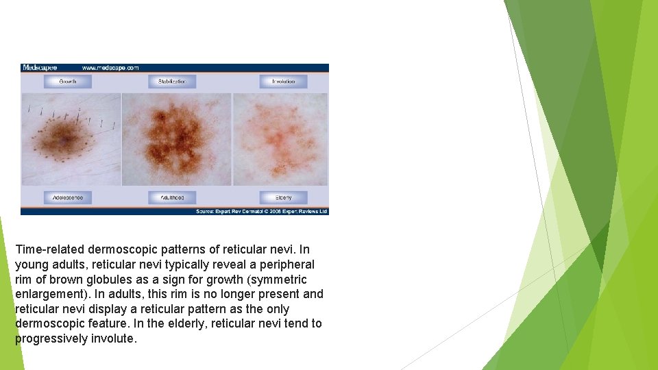 Time-related dermoscopic patterns of reticular nevi. In young adults, reticular nevi typically reveal a