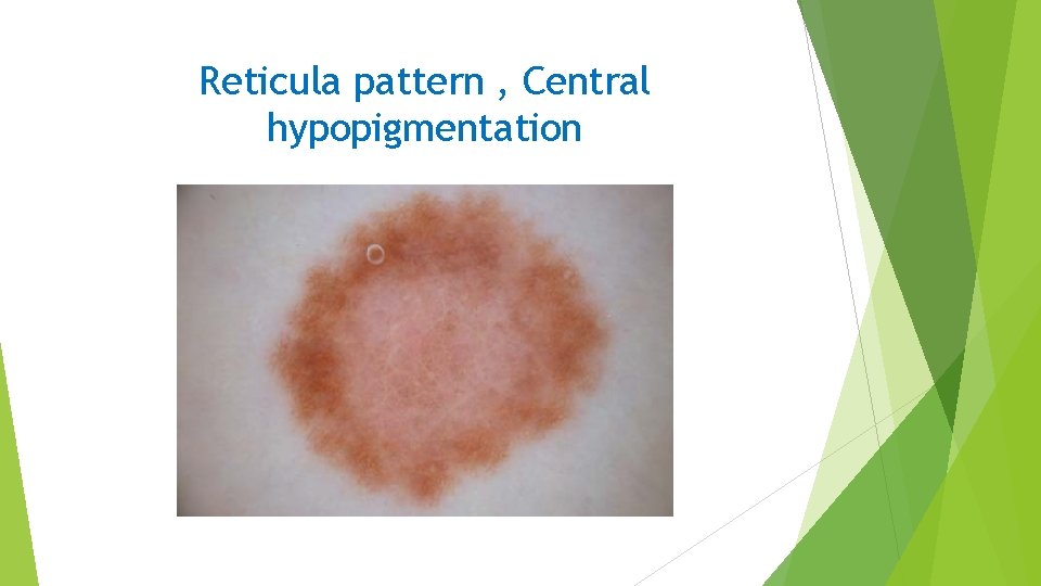 Reticula pattern , Central hypopigmentation 