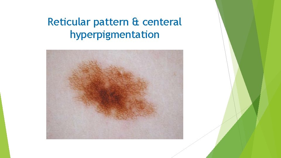 Reticular pattern & centeral hyperpigmentation 