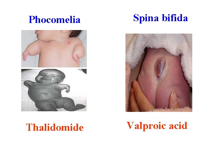 Phocomelia Spina bifida Thalidomide Valproic acid 