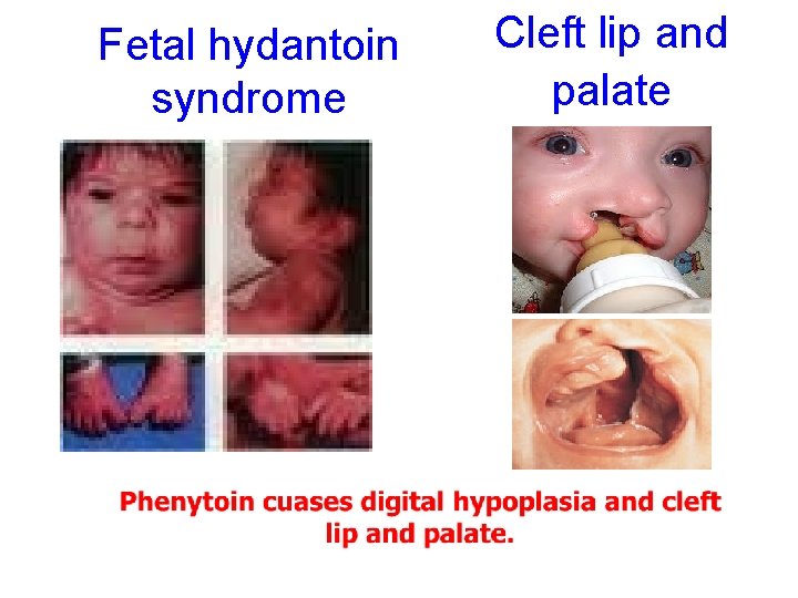 Fetal hydantoin syndrome Cleft lip and palate 