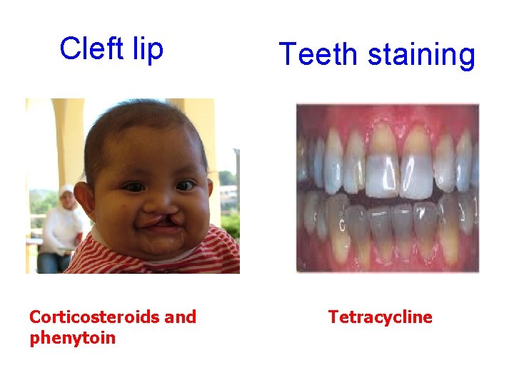 Cleft lip Teeth staining Corticosteroids and phenytoin Tetracycline 