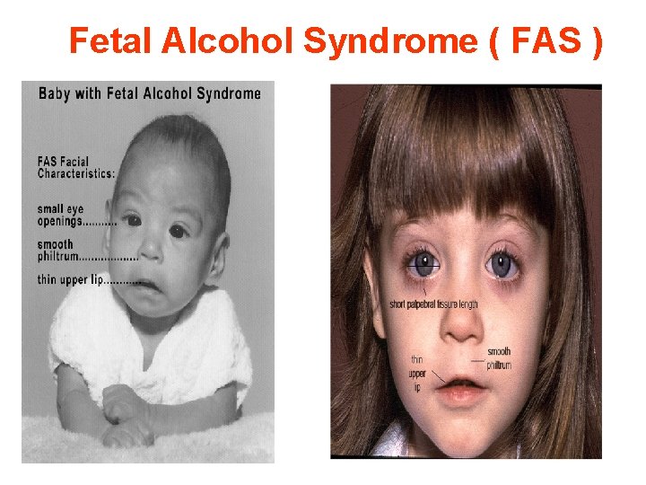 Fetal Alcohol Syndrome ( FAS ) 