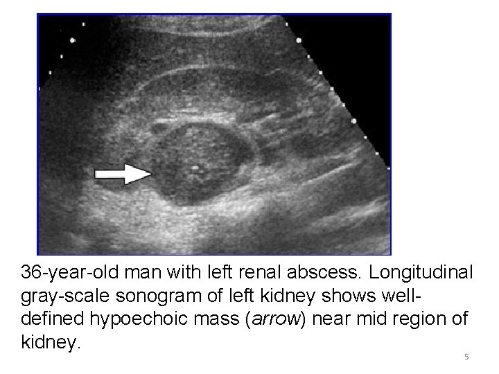 36 -year-old man with left renal abscess. Longitudinal gray-scale sonogram of left kidney shows