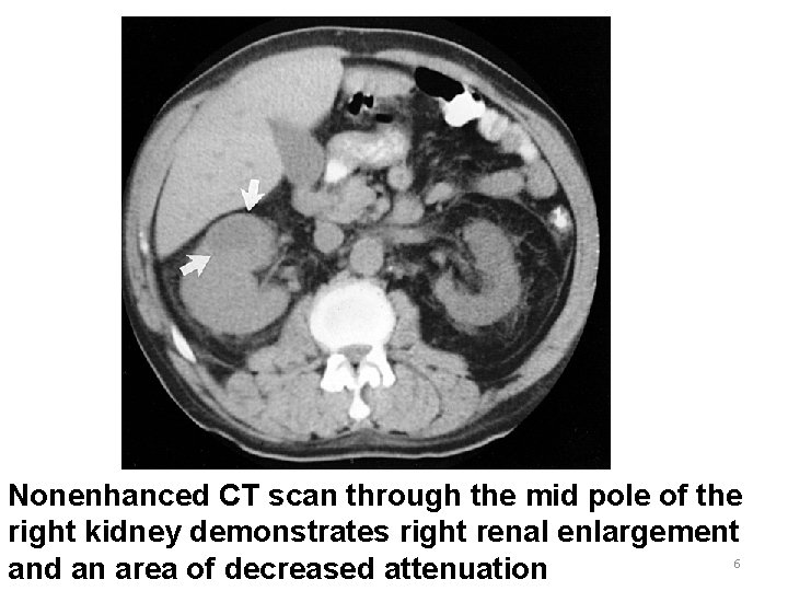 Nonenhanced CT scan through the mid pole of the right kidney demonstrates right renal
