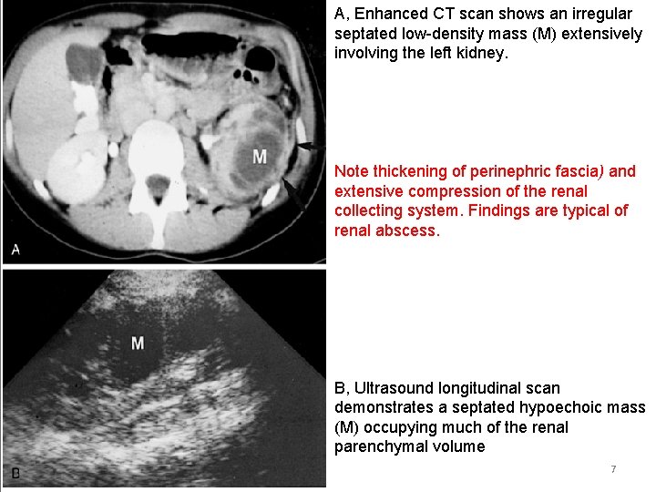 A, Enhanced CT scan shows an irregular septated low-density mass (M) extensively involving the