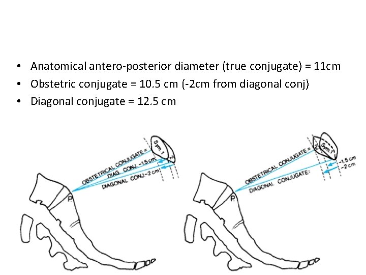  • Anatomical antero-posterior diameter (true conjugate) = 11 cm • Obstetric conjugate =