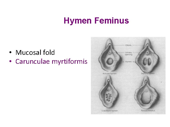Hymen Feminus • Mucosal fold • Carunculae myrtiformis 
