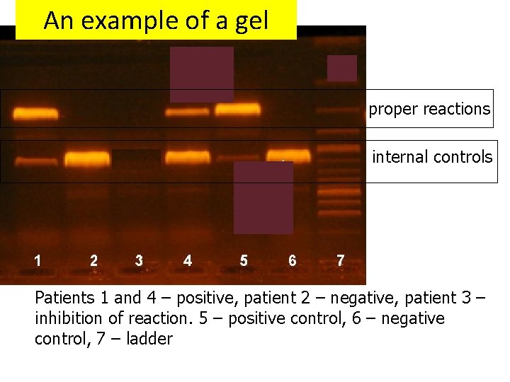 An example of a gel proper reactions internal controls Patients 1 and 4 –