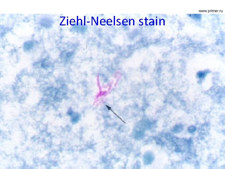 Ziehl-Neelsen stain www. primer. ru 