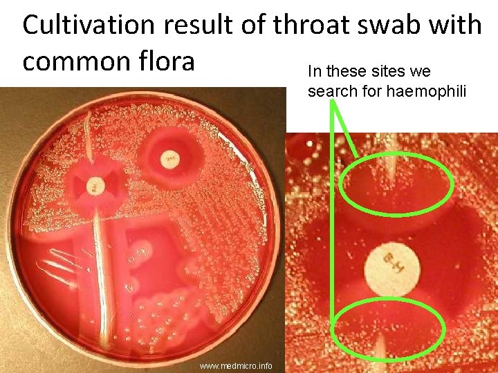 Cultivation result of throat swab with common flora In these sites we search for