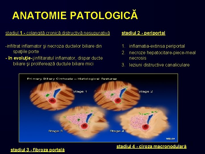 ANATOMIE PATOLOGICĂ stadiul 1 - colangită cronică distructivă nesupurativă stadiul 2 - periportal -infiltrat