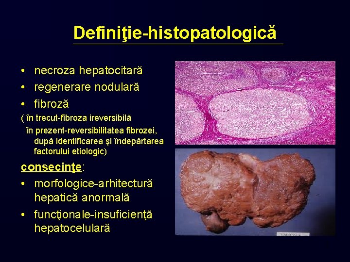 Definiţie-histopatologică • necroza hepatocitară • regenerare nodulară • fibroză ( în trecut-fibroza ireversibilă în