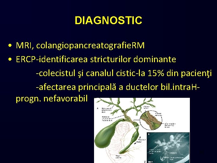 DIAGNOSTIC • MRI, colangiopancreatografie. RM • ERCP-identificarea stricturilor dominante -colecistul şi canalul cistic-la 15%