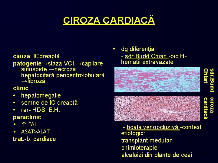 CIROZA CARDIACĂ sdr. Budd ciroza Chiari cardiacă cauza: ICdreaptă patogenie→staza VCI →capilare sinusoide →necroza