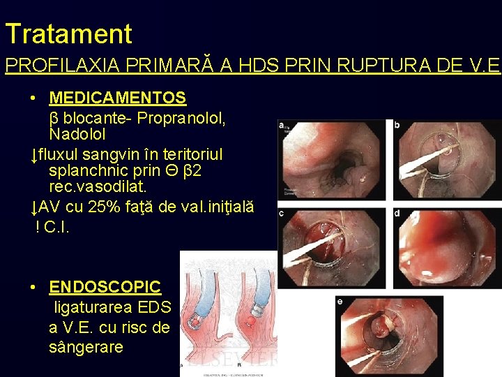 Tratament PROFILAXIA PRIMARĂ A HDS PRIN RUPTURA DE V. E. • MEDICAMENTOS β blocante-