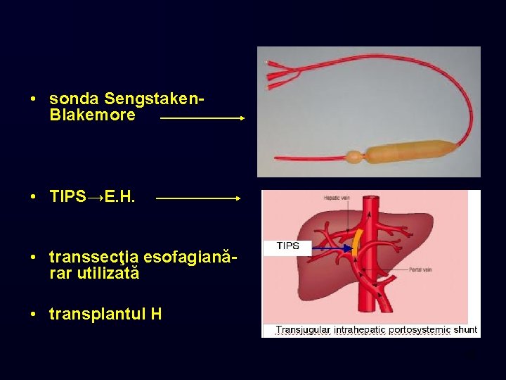  • sonda Sengstaken. Blakemore • TIPS→E. H. • transsecţia esofagianărar utilizată • transplantul