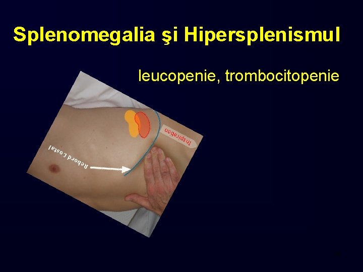 Splenomegalia şi Hipersplenismul leucopenie, trombocitopenie 48 