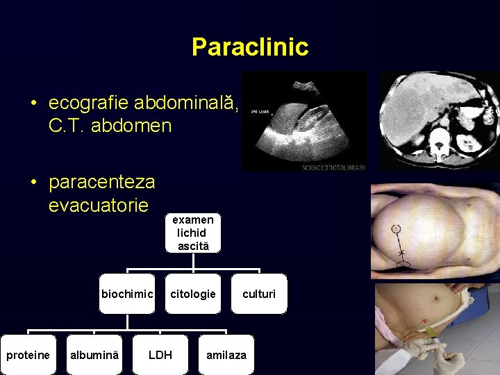 Paraclinic • ecografie abdominală, C. T. abdomen • paracenteza evacuatorie biochimic proteine albumină examen
