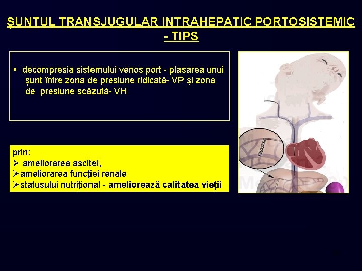 ȘUNTUL TRANSJUGULAR INTRAHEPATIC PORTOSISTEMIC - TIPS § decompresia sistemului venos port - plasarea unui