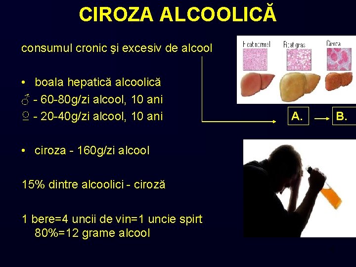 CIROZA ALCOOLICĂ consumul cronic şi excesiv de alcool • boala hepatică alcoolică ♂ -