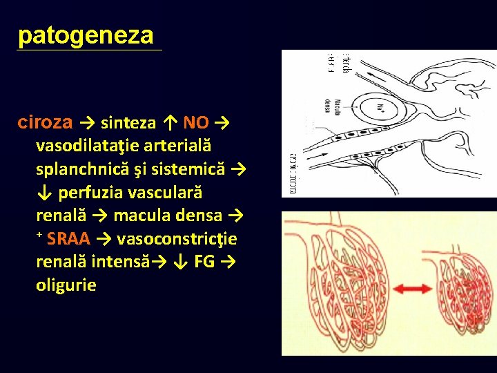 patogeneza ciroza → sinteza ↑ NO → vasodilataţie arterială splanchnică şi sistemică → ↓
