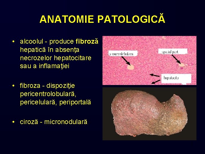 ANATOMIE PATOLOGICĂ • alcoolul - produce fibroză hepatică în absenţa necrozelor hepatocitare sau a