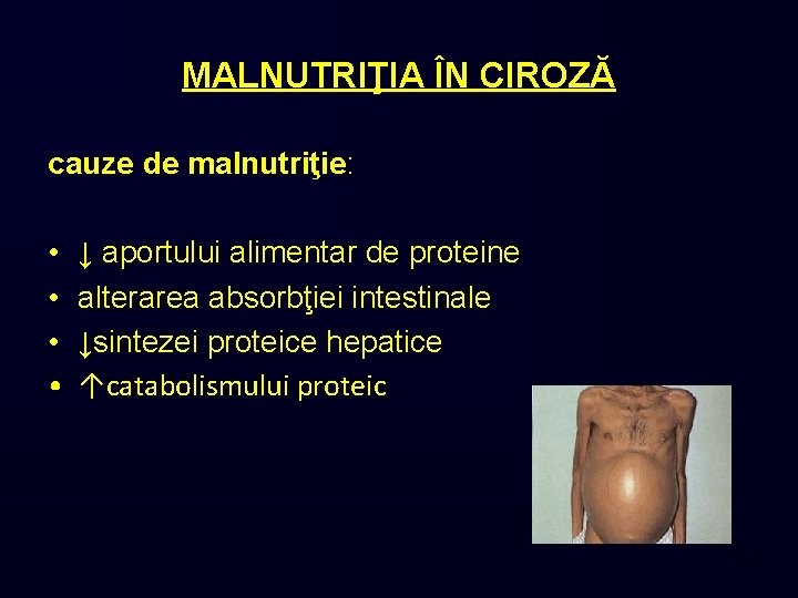 MALNUTRIŢIA ÎN CIROZĂ cauze de malnutriţie: • • ↓ aportului alimentar de proteine alterarea