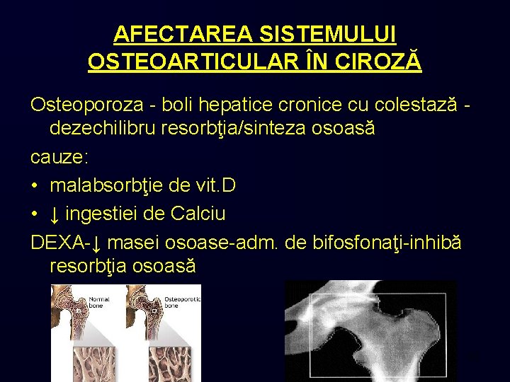 AFECTAREA SISTEMULUI OSTEOARTICULAR ÎN CIROZĂ Osteoporoza - boli hepatice cronice cu colestază dezechilibru resorbţia/sinteza