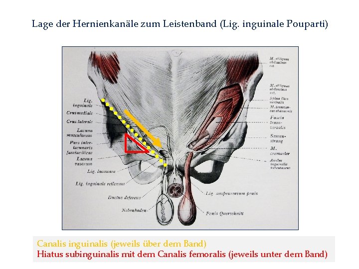 Lage der Hernienkanäle zum Leistenband (Lig. inguinale Pouparti) Canalis inguinalis (jeweils über dem Band)